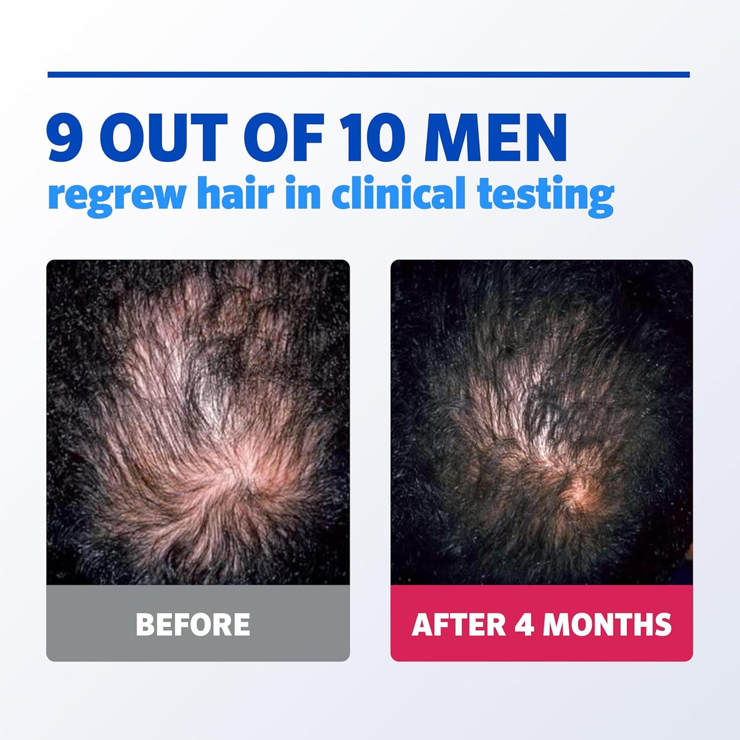 Men's Rogaine 5% Minoxidil Foam for Hair Regrowth, Topical Hair Loss Treatment for Men to Regrow Fuller, Thicker Hair, Unscented Minoxidil Topical Aerosol, 3-Month Supply, 3 x 2.11 oz
